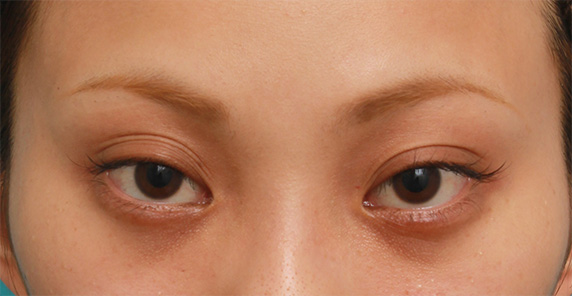キツいつり目にヒアルロン酸注射で涙袋を作り、優しい印象の目にした症例写真の術前術後,Before,ba_namida17_b.jpg