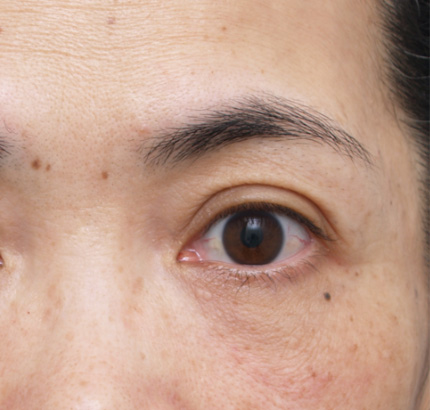 目の下のクマ治療,ベビーコラーゲン,目の下のクマ治療の症例　コラーゲン注入,After,ba_kuma11_a01.jpg