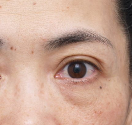 目の下のクマ治療,ベビーコラーゲン,目の下のクマ治療の症例　コラーゲン注入,Before,ba_kuma11_b.jpg