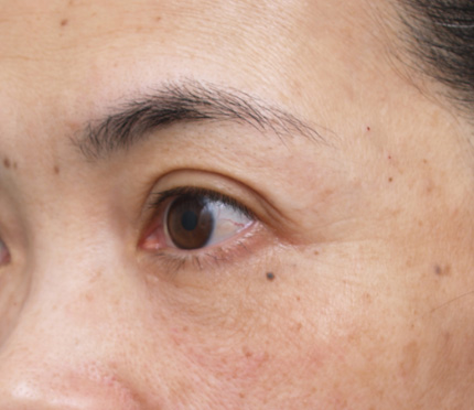 目の下のクマ治療,目の下のクマ治療の症例　コラーゲン注入,After,ba_kuma12_b.jpg