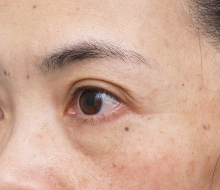 ベビーコラーゲン,目の下のクマ治療の症例　コラーゲン注入,Before,ba_kuma12_b.jpg