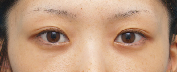 目の下のクマ治療,目の下のクマ治療の症例 遺伝的に下まぶたの脂肪がつきやすいやすい20代女性,After（メイクなし）,ba_kuma09_b.jpg