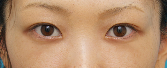 目の下のクマ治療,目の下のクマ治療の症例 遺伝的に下まぶたの脂肪がつきやすいやすい20代女性,After（メイクあり）<br/>
（1週間後）,