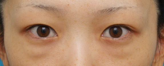 目の下の脂肪取り,目の下のクマ治療の症例 遺伝的に下まぶたの脂肪がつきやすいやすい20代女性,Before,ba_kuma09_b.jpg