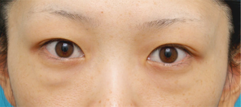 目の下の脂肪取り,目の下のクマ治療の症例 遺伝的に下まぶたの脂肪がつきやすいやすい20代女性,施術前,mainpic_kuma02a.jpg