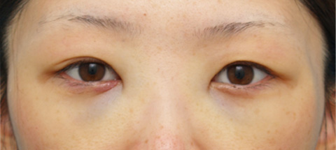 目の下の脂肪取り,目の下のクマ治療の症例 遺伝的に下まぶたの脂肪がつきやすいやすい20代女性,施術直後,mainpic_kuma02b.jpg