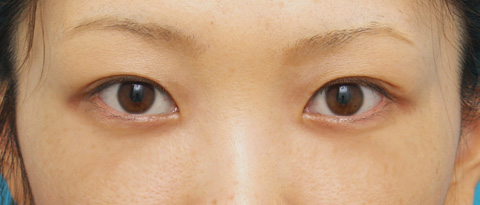 目の下の脂肪取り,目の下のクマ治療の症例 遺伝的に下まぶたの脂肪がつきやすいやすい20代女性,1週間後,メイクあり,mainpic_kuma02c.jpg
