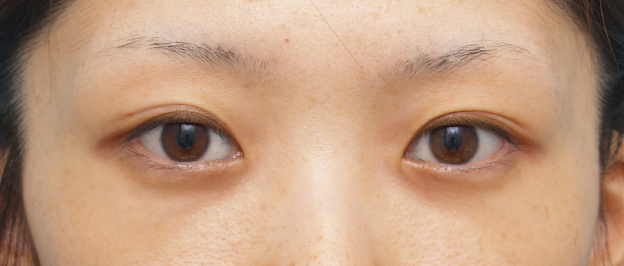 目の下の脂肪取り,目の下のクマ治療の症例 遺伝的に下まぶたの脂肪がつきやすいやすい20代女性,1週間後,メイクなし,mainpic_kuma02d.jpg