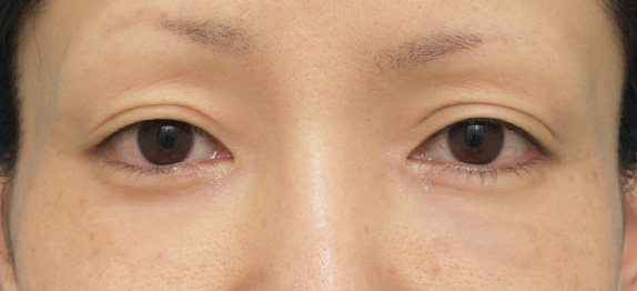目の下のクマ治療,目の下のクマ治療の症例 長期持続型ヒアルロン酸注入の注射式シワ取り,After（3日後）,ba_kuma08_b.jpg