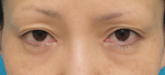 目の下のクマ治療,目の下のクマ治療の症例 長期持続型ヒアルロン酸注入の注射式シワ取り,Before,ba_kuma08_b.jpg