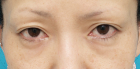 目の下のクマ治療,目の下のクマ治療の症例 長期持続型ヒアルロン酸注入の注射式シワ取り,施術前,mainpic_kuma01a.jpg
