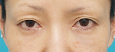 注射式シワ取り 長期持続型ヒアルロン酸注入,目の下のクマ治療の症例 長期持続型ヒアルロン酸注入の注射式シワ取り,施術直後,mainpic_kuma01b.jpg