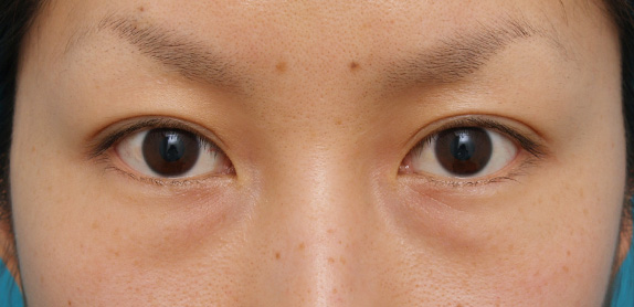 目の下のクマ治療,目の下のクマ治療の症例 20代女性の目の下の脂肪取り /クマ治療,Before,ba_kuma07_b.jpg