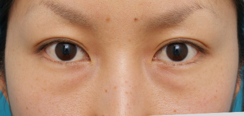目の下のクマ治療,目の下のクマ治療の症例 20代女性の目の下の脂肪取り /クマ治療,施術前,mainpic_kuma03a.jpg