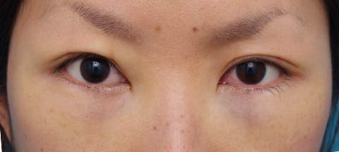 目の下の脂肪取り,目の下のクマ治療の症例 20代女性の目の下の脂肪取り /クマ治療,施術直後,mainpic_kuma03b.jpg