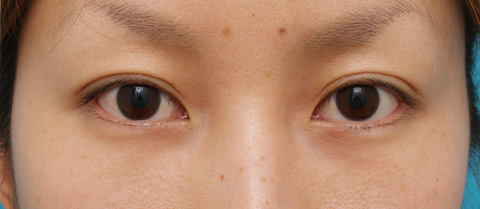 目の下のクマ治療,目の下のクマ治療の症例 20代女性の目の下の脂肪取り /クマ治療,1週間後,mainpic_kuma03c.jpg