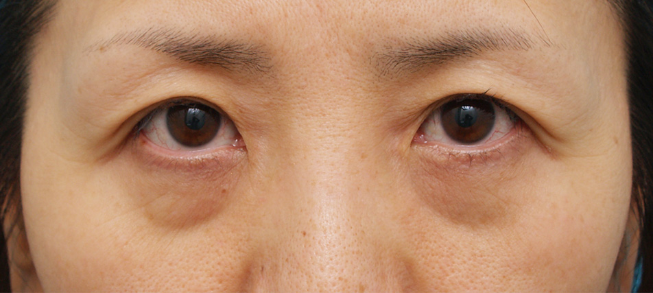目の下のクマ治療,目の下のクマ治療の症例 くぼんで陰になっているタイプのクマにはヒアルロン酸注入,Before,ba_kuma06_b.jpg