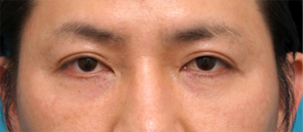 目の下のくぼみにヒアルロン酸を注射した症例写真,After（1週間後）,ba_kuma13_a01.jpg
