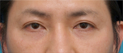 目の下のクマ治療,目の下のくぼみにヒアルロン酸を注射した症例写真,1週間後,mainpic_kuma04c.jpg