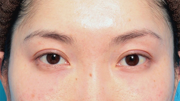 目の下のクマ治療,目の下のクマの原因の窪みにヒアルロン酸注射をして改善させた症例写真の術前術後画像,After（1週間後）,ba_kuma15_b.jpg