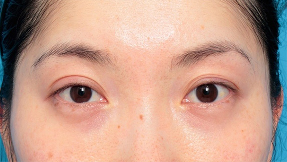 目の下のクマ治療,目の下のクマの原因の窪みにヒアルロン酸注射をして改善させた症例写真の術前術後画像,Before,ba_kuma15_b.jpg