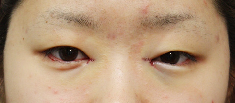 症例写真,蒙古ひだ形成・目頭切開後の修正症例 他院での二重まぶた・目もと手術の修正,施術直後,mainpic_hida02b.jpg