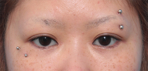 他院で目頭切開を必要以上に切り過ぎてきつくなった目を蒙古襞形成で修正した症例写真,After（2ヶ月後）,ba_hida05_a01.jpg