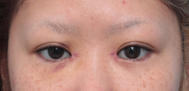 他院で受けた手術の修正（二重まぶた・目もと）,他院で目頭切開を必要以上に切り過ぎてきつくなった目を蒙古襞形成で修正した症例写真,1週間後,mainpic_hida04c.jpg