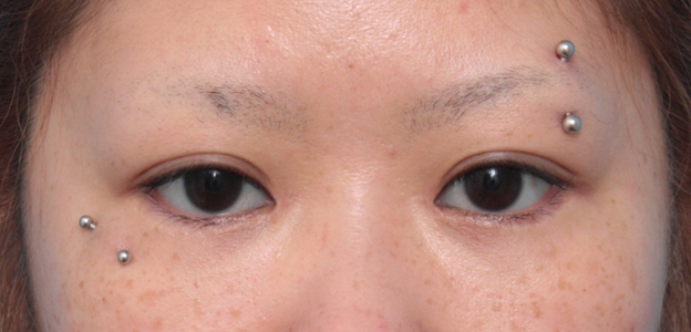 他院で受けた手術の修正（二重まぶた・目もと）,他院で目頭切開を必要以上に切り過ぎてきつくなった目を蒙古襞形成で修正した症例写真,2ヶ月後,mainpic_hida04d.jpg