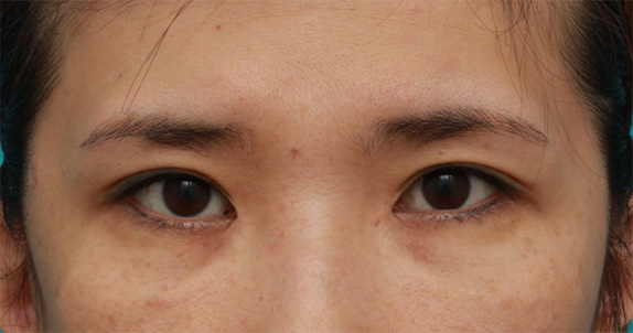 蒙古ひだ形成・目頭切開後の修正,他院で受けた目頭切開を蒙古襞形成で修正手術した症例写真の術前術後の画像の解説,After（6ヶ月後）,ba_hida06_b.jpg