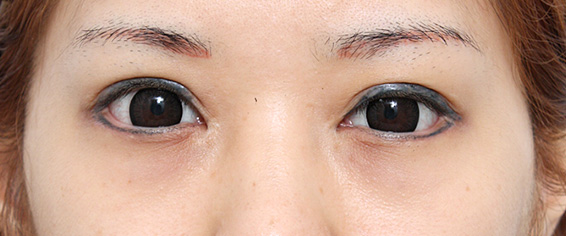 症例写真,垂れ目（パンダ目）形成（グラマラスライン／下眼瞼下制術）の症例 20代女性の術後1週間、抜糸時の様子,After（1週間後）,ba_panda02_b.jpg