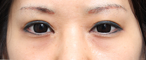 症例写真,垂れ目（パンダ目）形成（グラマラスライン／下眼瞼下制術）の症例 20代女性の術後1週間、抜糸時の様子,施術前,mainpic_panda02a.jpg