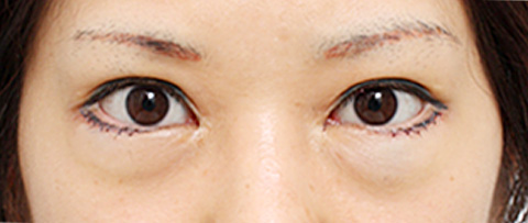 垂れ目（パンダ目）形成（グラマラスライン／下眼瞼下制術）,垂れ目（パンダ目）形成（グラマラスライン／下眼瞼下制術）の症例 20代女性の術後1週間、抜糸時の様子,施術直後,mainpic_panda02b.jpg