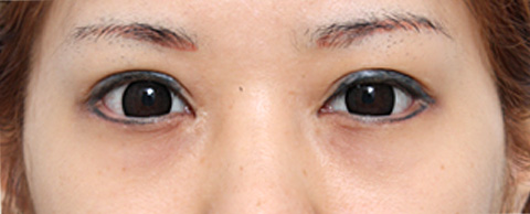 症例写真,垂れ目（パンダ目）形成（グラマラスライン／下眼瞼下制術）の症例 20代女性の術後1週間、抜糸時の様子,1週間後,mainpic_panda02c.jpg