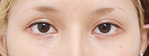 垂れ目（パンダ目）形成（グラマラスライン／下眼瞼下制術）,垂れ目（パンダ目）形成（グラマラスライン／下眼瞼下制術）の症例 癒し系の目もとが憧れの20代女性,After（1ヶ月後）,ba_panda03_b.jpg