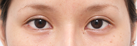 垂れ目（パンダ目）形成（グラマラスライン／下眼瞼下制術）,垂れ目（パンダ目）形成（グラマラスライン／下眼瞼下制術）の症例 癒し系の目もとが憧れの20代女性,施術前,mainpic_panda03a.jpg