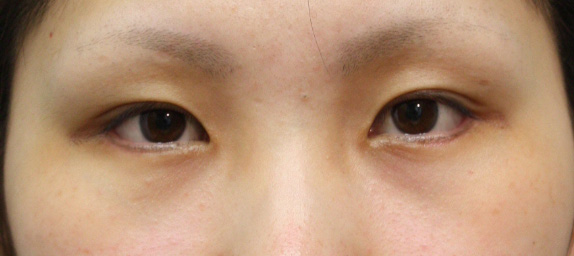 症例写真,垂れ目（パンダ目）形成（グラマラスライン／下眼瞼下制術）の症例 きつく見られるつり目がコンプレックスだった女性,After（1ヶ月後）,ba_panda01_b.jpg