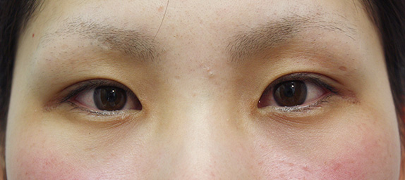 症例写真,垂れ目（パンダ目）形成（グラマラスライン／下眼瞼下制術）の症例 きつく見られるつり目がコンプレックスだった女性,Before,ba_panda01_b.jpg