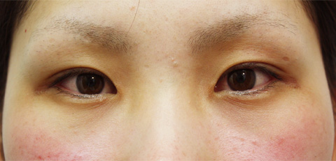 垂れ目（パンダ目）形成（グラマラスライン／下眼瞼下制術）,垂れ目（パンダ目）形成（グラマラスライン／下眼瞼下制術）の症例 きつく見られるつり目がコンプレックスだった女性,施術前,mainpic_panda01a.jpg