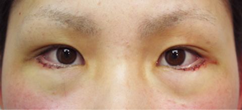垂れ目（パンダ目）形成（グラマラスライン／下眼瞼下制術）,垂れ目（パンダ目）形成（グラマラスライン／下眼瞼下制術）の症例 きつく見られるつり目がコンプレックスだった女性,施術直後,mainpic_panda01b.jpg
