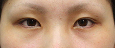 垂れ目（パンダ目）形成（グラマラスライン／下眼瞼下制術）,垂れ目（パンダ目）形成（グラマラスライン／下眼瞼下制術）の症例 きつく見られるつり目がコンプレックスだった女性,1ヶ月後,mainpic_panda01c.jpg