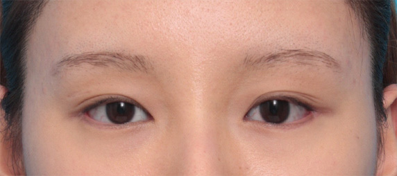 垂れ目形成+目尻切開で目が一回り大きくなり、優しい目元になった症例写真,After（3ヶ月後）,ba_panda04_a01.jpg