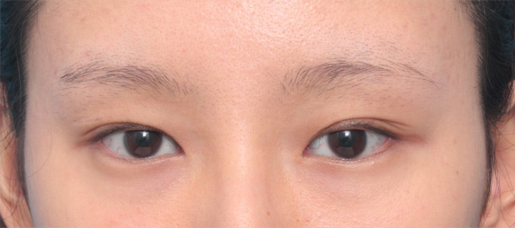 垂れ目形成+目尻切開で目が一回り大きくなり、優しい目元になった症例写真,Before,ba_panda04_b.jpg