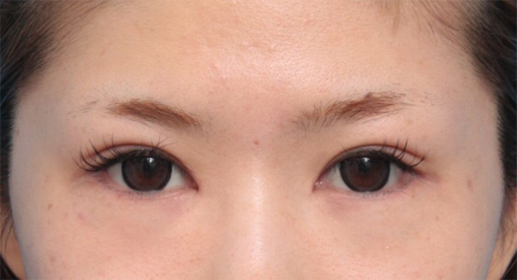 垂れ目（パンダ目）形成（グラマラスライン／下眼瞼下制術）,目頭切開+タレ目形成で、目を一回り大きくした症例写真,After（6ヶ月後）,ba_panda05_b.jpg