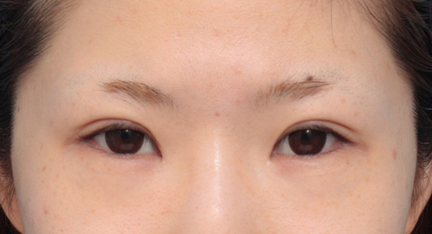 垂れ目（パンダ目）形成（グラマラスライン／下眼瞼下制術）,目頭切開+タレ目形成で、目を一回り大きくした症例写真,手術前,mainpic_panda05a.jpg