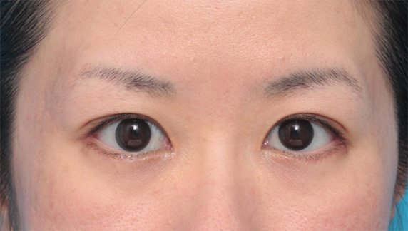 目尻切開,垂れ目（パンダ目）形成（グラマラスライン／下眼瞼下制術）,目尻切開+たれ目形成術（グラマラスライン）で目を外側と下方に大きくした症例写真,After（4ヶ月後）,ba_panda06_a01.jpg