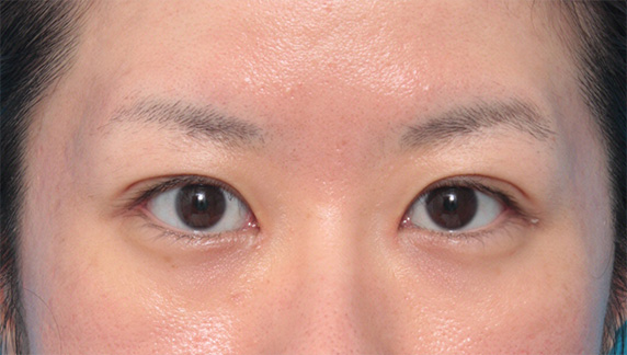 目尻切開,垂れ目（パンダ目）形成（グラマラスライン／下眼瞼下制術）,目尻切開+たれ目形成術（グラマラスライン）で目を外側と下方に大きくした症例写真,Before,ba_panda06_b.jpg