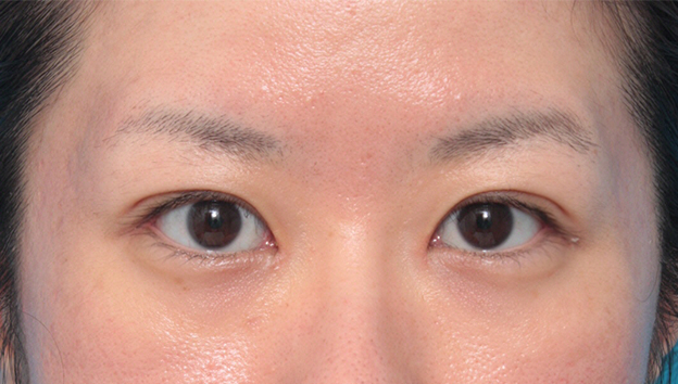 目尻切開,目尻切開+たれ目形成術（グラマラスライン）で目を外側と下方に大きくした症例写真,手術前,mainpic_panda06a.jpg