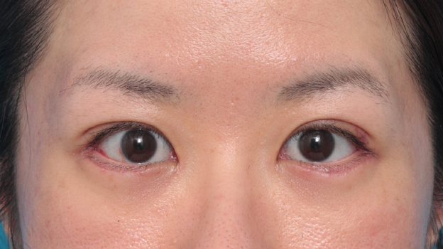 垂れ目（パンダ目）形成（グラマラスライン／下眼瞼下制術）,目尻切開+たれ目形成術（グラマラスライン）で目を外側と下方に大きくした症例写真,1週間後,mainpic_panda06c.jpg