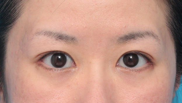 垂れ目（パンダ目）形成（グラマラスライン／下眼瞼下制術）,目尻切開+たれ目形成術（グラマラスライン）で目を外側と下方に大きくした症例写真,4ヶ月後,mainpic_panda06d.jpg